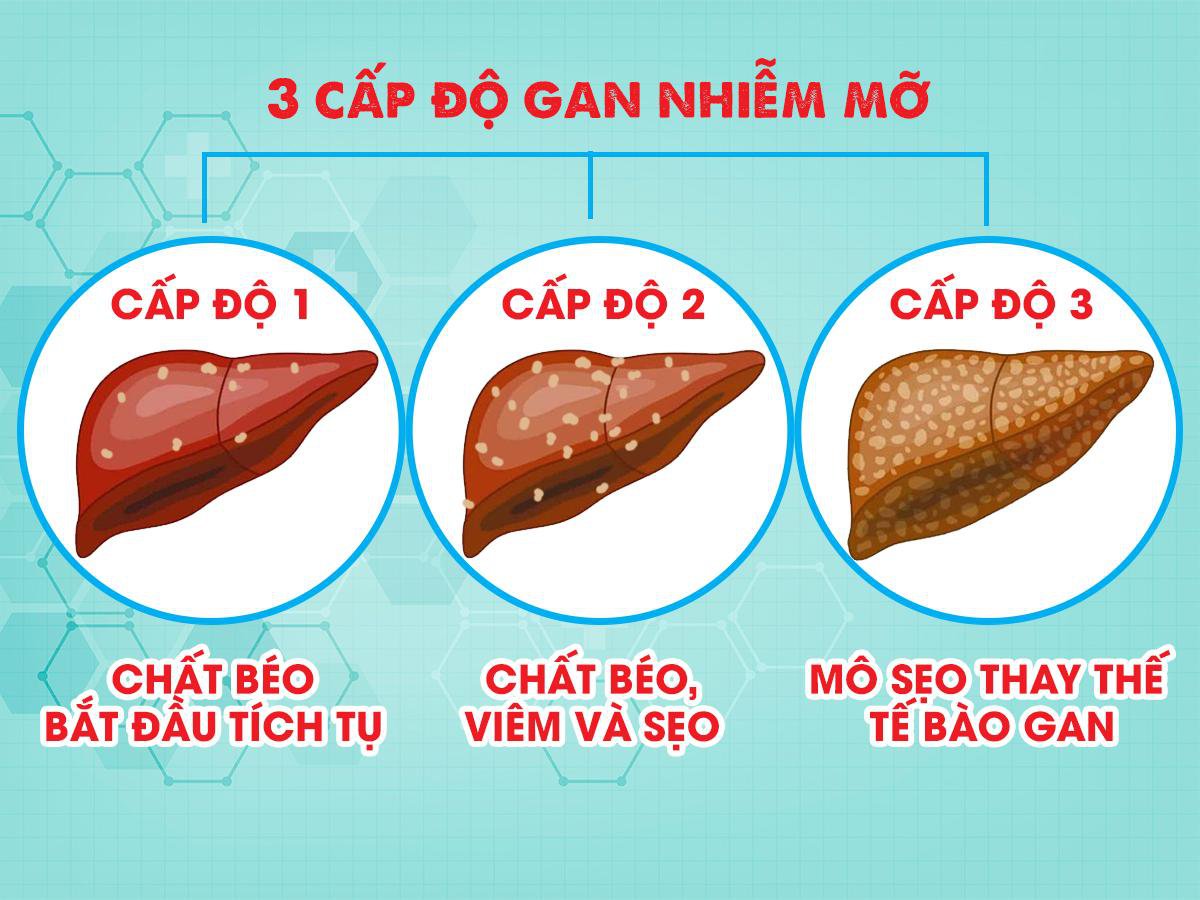 Gan Nhiễm Mỡ Mấy Cấp Độ: Tìm Hiểu Chi Tiết Và Phương Pháp Phòng Ngừa